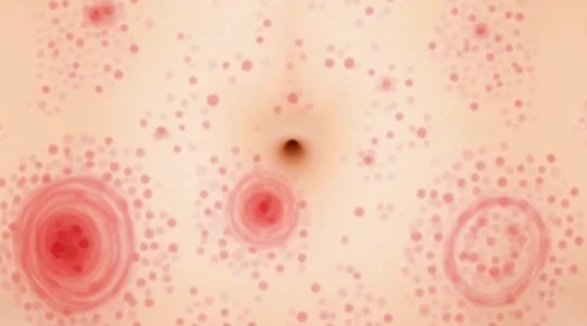 common-rashes-on-the-stomach-visual-guide